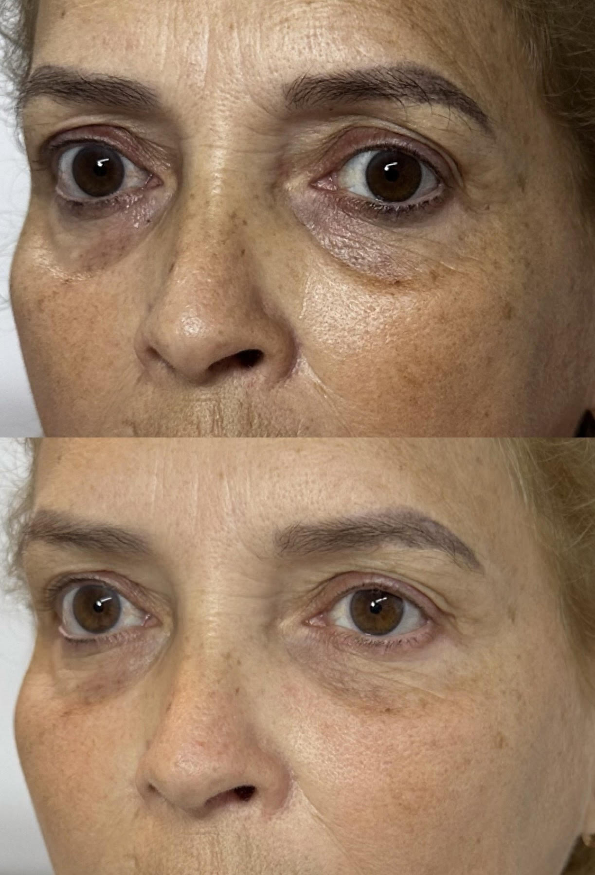 Resultado de Olheiras